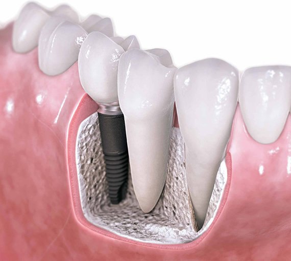 Cerrahi & Dental İmplant